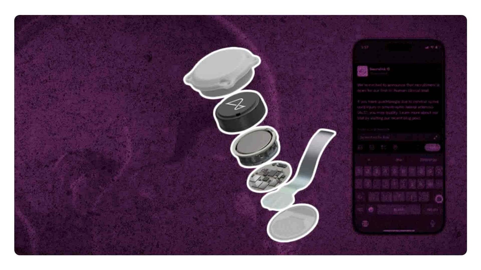 Neuralink implanta su primer chip en cerebro humano