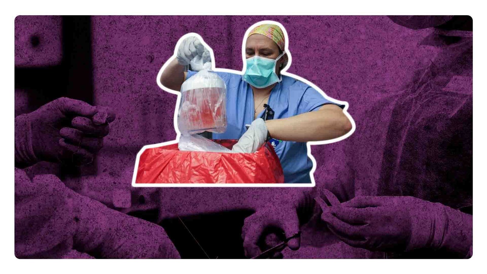 ¡Histórico! Primer trasplante de riñón de cerdo a una persona viva