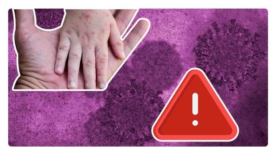 Emitén alerta epidemiológica por casos de sarampión: ¿A qué edad se pone la vacuna?